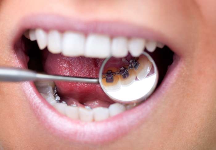 What Are Lingual Braces?