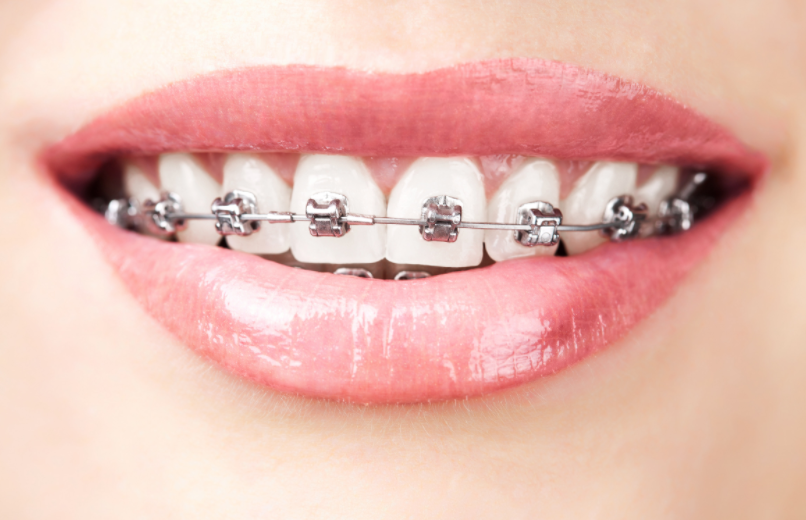 How Much Do Metal Braces Cost?