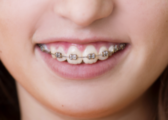 What Are Metal Braces?