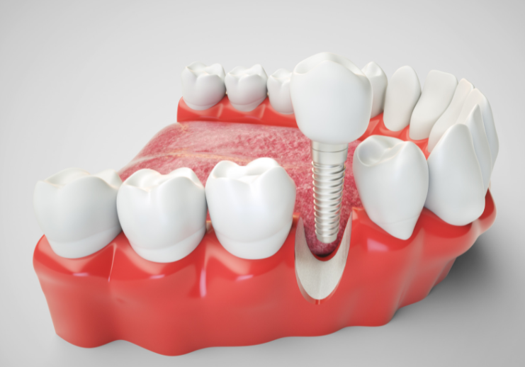 How To Choose A Good Dental Implant Dentist