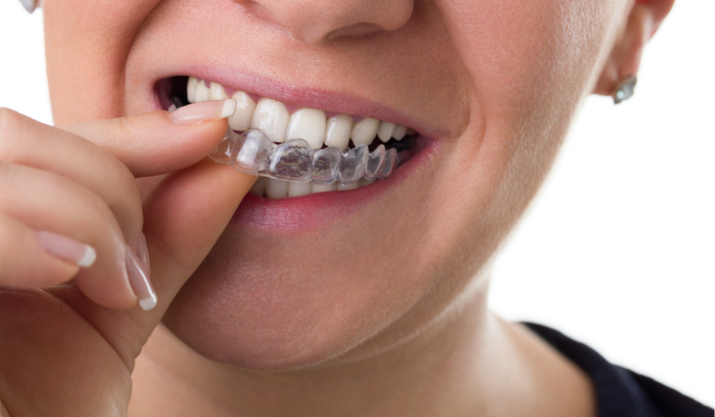 Adult Orthodontics – Choosing Between Invisalign and Other Methods