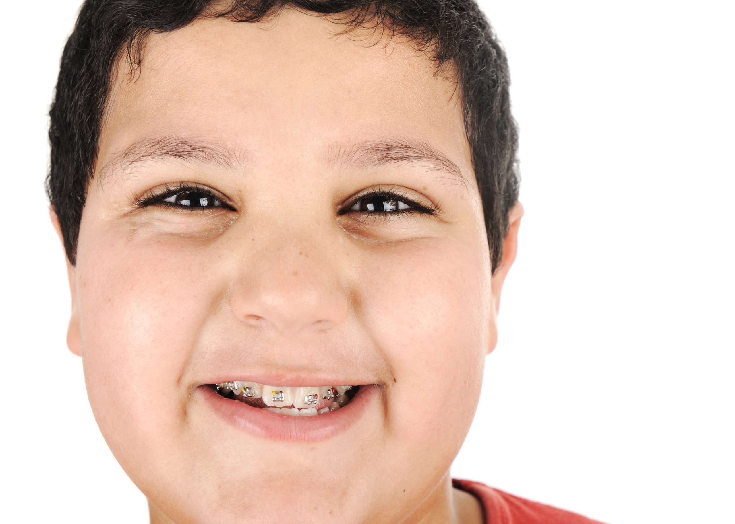 Straighten Up! The Benefits of Using Invisalign for Orthodontic Treatment