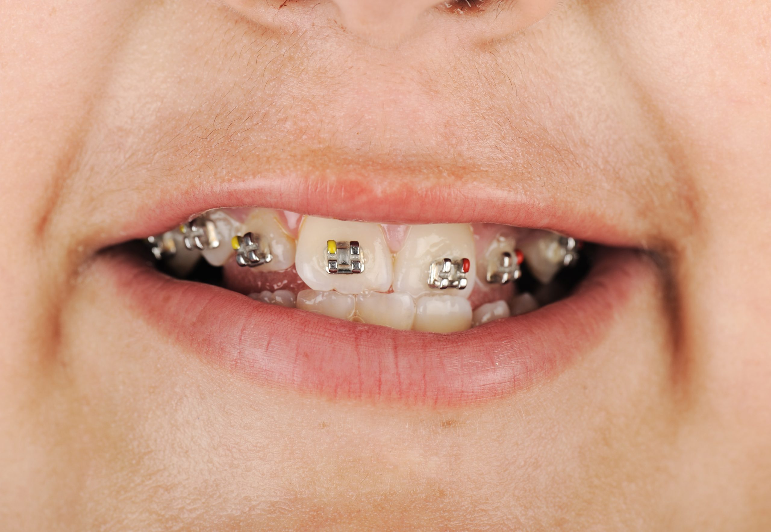 Getting Comfortable with Dental Braces: Tips and Tricks for a Smooth Transition