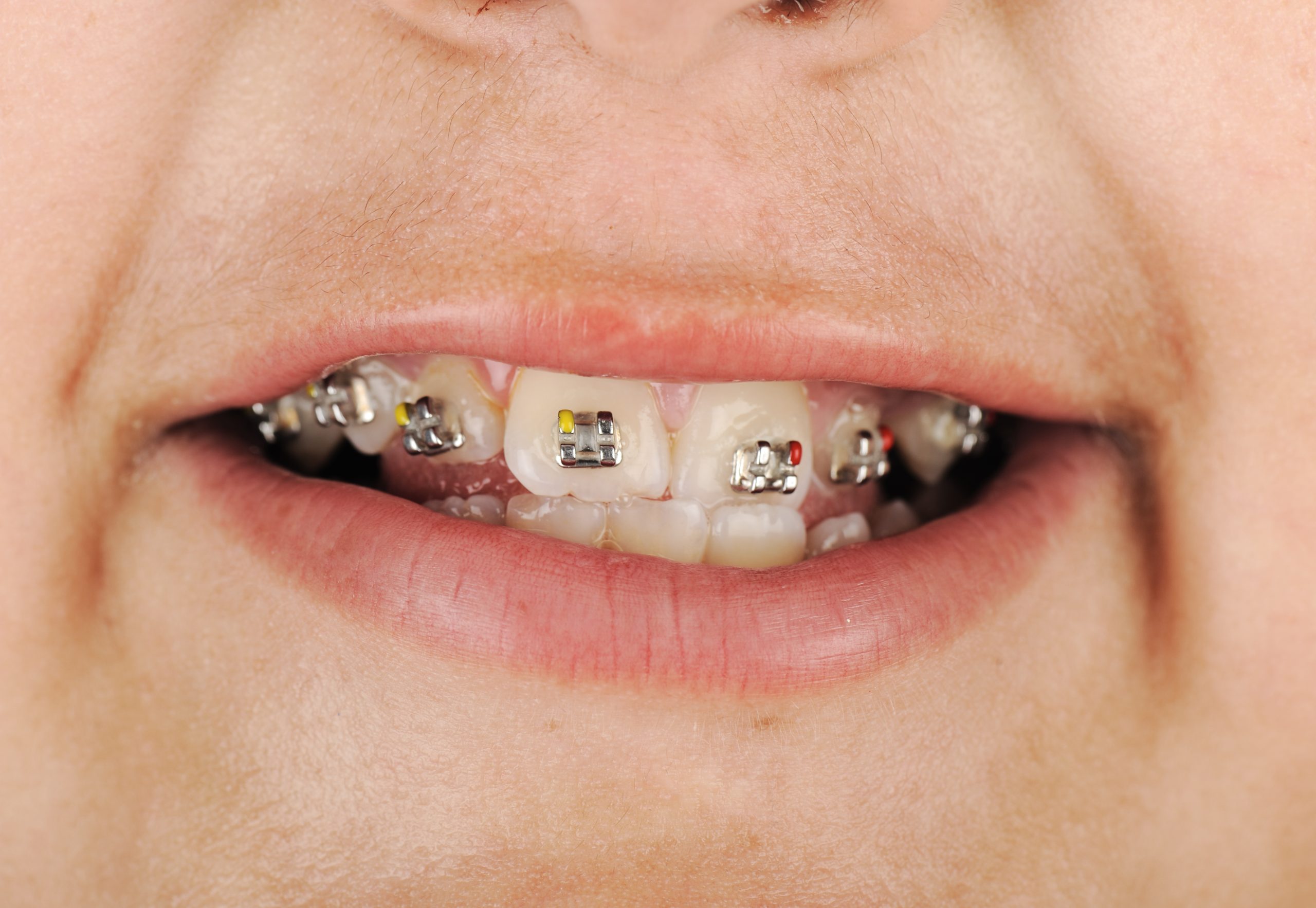 Ceramic Braces Vs. Traditional Metal Braces